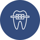 Trattamento con allineatori trasparenti per l’allineamento discreto dei denti
